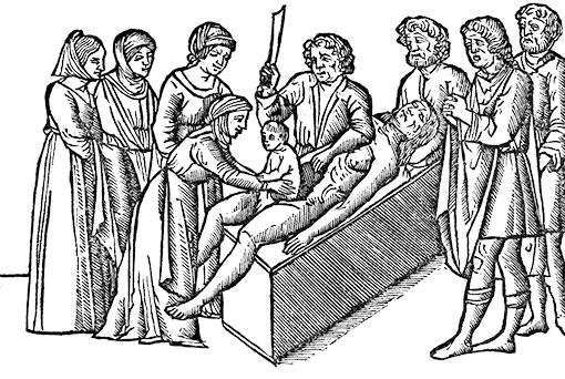 Woodcut illustration from 1506 of the birth of Julius Caesar by Caesarian section.
